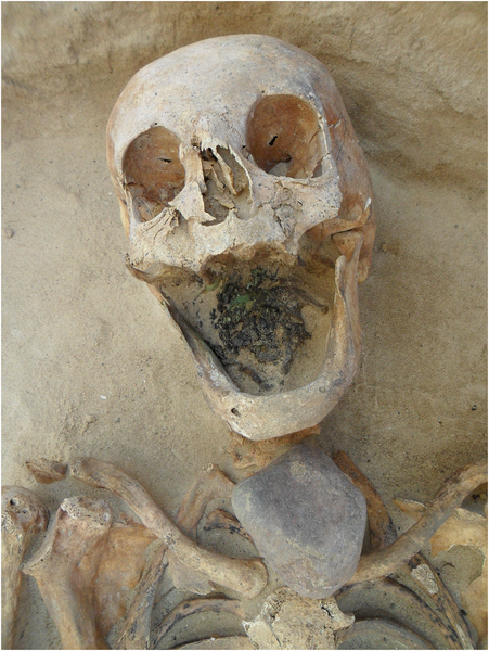 Una donna di 45-49 anni con una pietra sulla gola (Lesley A. Gregoricka et al.,CC)